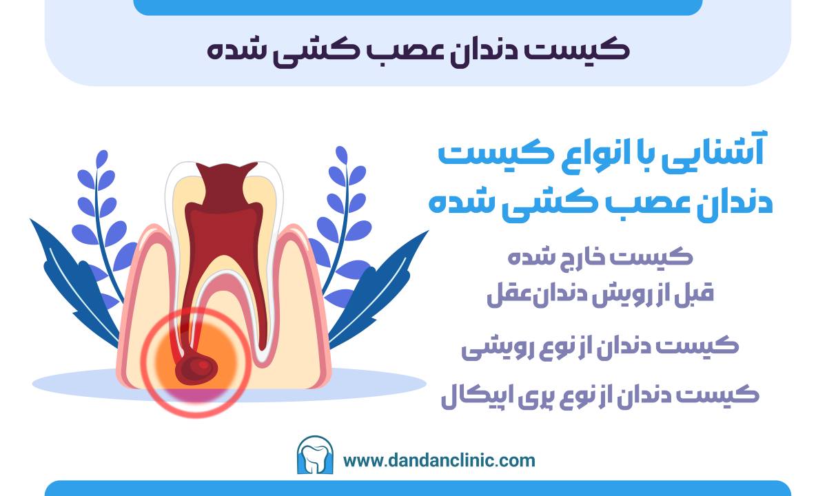 کیست دندان عصب کشی شده